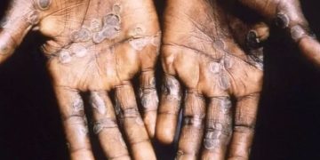 Cacar Monyet Dipastikan Tidak Akan Jadi Pandemi