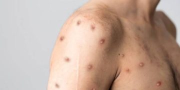 Jangan Panik, Berikut Cara Pencegahan dan Pengobatan Cacar Monyet 